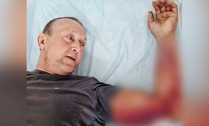 Готовил суп, а попал в реанимацию: Житель Челнов чудом выжил после укуса гадюки
