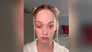 У ведущей «Женского 100500» опустилось веко после уколов ботокса от мигрени