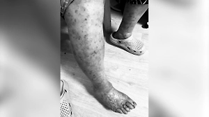 «Перепутала с лопухом»: Подмосковная пенсионерка получила ожоги от борщевика, собирая травы