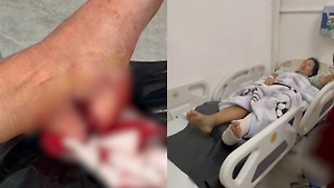 Россиянке оторвало часть пятки при падении в колодец в отеле на Занзибаре