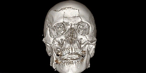Подмосковные врачи семь часов собирали по кусочкам лицо пациента, упавшего со снегохода