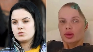 Жертва «подмосковного Отелло» дала совет модели Тартановой, помирившейся со снёсшим ей полчерепа парнем