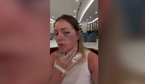 Сломанные пальцы и фингал: Россиянку избили в отеле во Вьетнаме за попытку защитить дочку