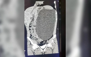 17-летний сибиряк вырастил почку размером с пятилитровую бутылку