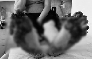 Пузыри и гной: Россиянин чуть не лишился стоп из-за раствора для полов