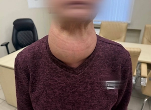 Россиянка 40 лет прожила с огромной опухолью щитовидки из-за дикой боязни врачей