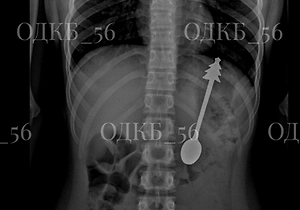 В Оренбурге врачи спасли ребёнка с 14-сантиметровой ложкой в желудке