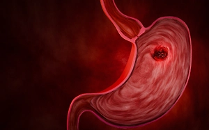 Названы главные симптомы рака желудка и пищевода