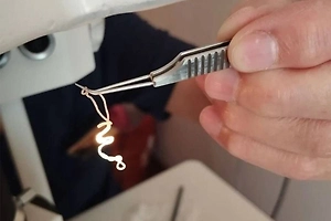 Живого червя достали из глаза пациента в Чебоксарах — «поселил» его туда комар