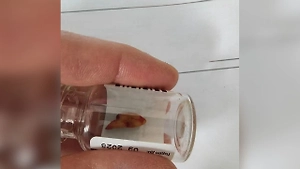 Мужчина чуть не задохнулся из-за «переехавшего» в нос зуба