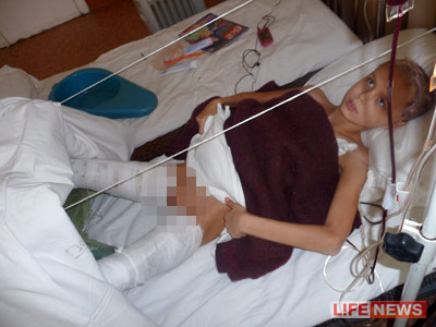 %D0%A0%D0%B5%D0%B1%D0%B5%D0%BD%D0%BE%D0%BA%20%D0%BF%D0%BE%D0%BB%D1%83%D1%87%D0%B8%D0%BB%20%D1%81%D0%B8%D0%BB%D1%8C%D0%BD%D0%B5%D0%B9%D1%88%D0%B8%D0%B5%20%D0%BE%D0%B6%D0%BE%D0%B3%D0%B8%20%D0%BD%D0%BE%D0%B3