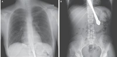 15-%D1%81%D0%B0%D0%BD%D1%82%D0%B8%D0%BC%D0%B5%D1%82%D1%80%D0%BE%D0%B2%D1%8B%D0%B9%20%D0%BD%D0%BE%D0%B6%20%D0%BF%D0%BE%D0%BF%D0%B0%D0%BB%20%D0%B2%20%D0%BF%D0%B8%D1%89%D0%B5%D0%B2%D0%BE%D0%B4%20%D0%BF%D0%BE%D1%81%D0%BB%D0%B5%20%D1%82%D1%80%D1%8E%D0%BA%D0%B0%20(%D1%84%D0%BE%D1%82%D0%BE%3A%20nejm.org)