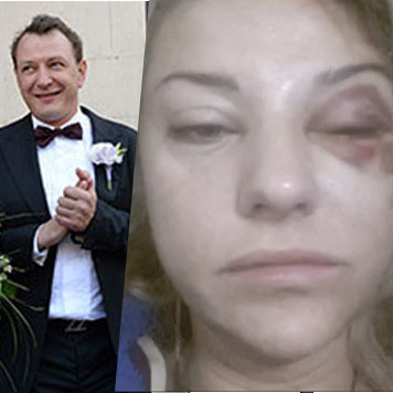 Избитая жена башарова фото. Жена Марата Башарова избитая.