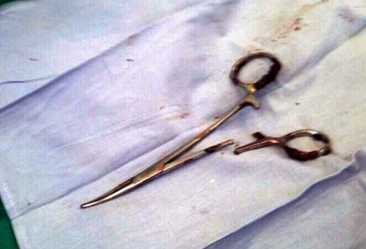 Во Вьетнаме у мужчины из желудка достали ножницы спустя 18 лет после операции