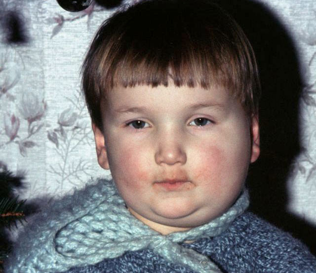 5-летний мальчик с типичным припуханием околоушных слюнных желёз. Фото: © wikipedia.org
