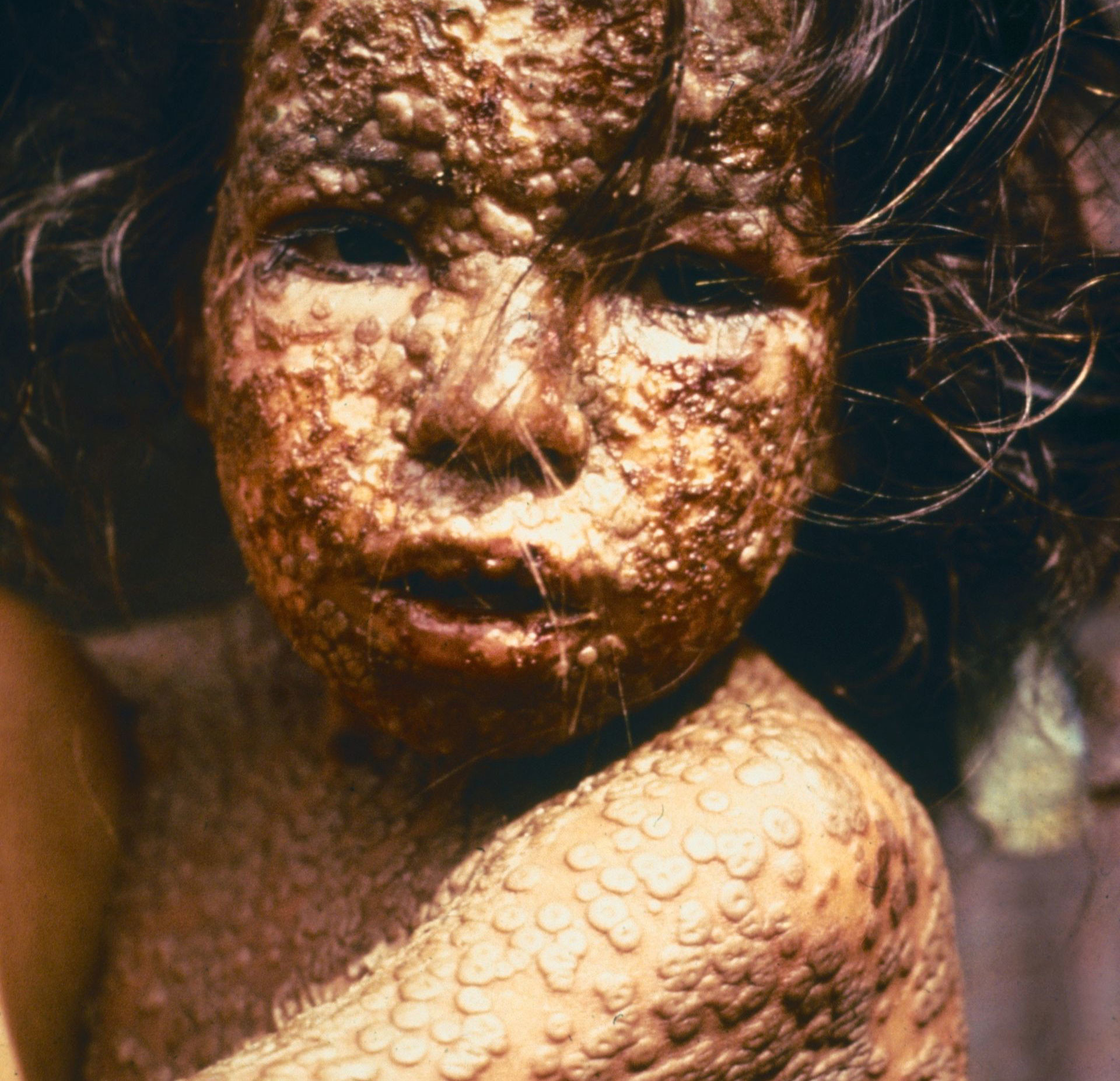 Ребёнок, больной оспой. Фото: © wikipedia.org