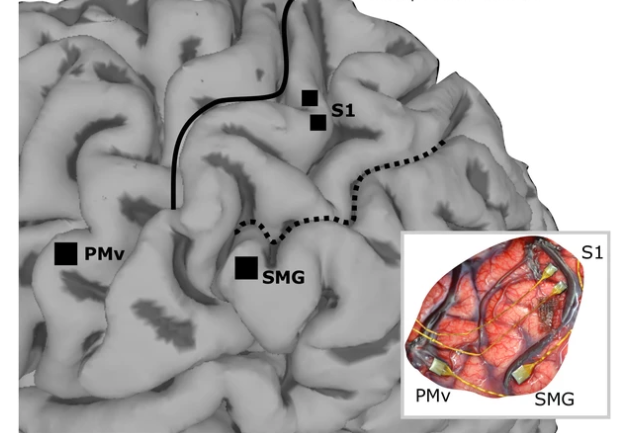 Расположение имплантов в левом полушарии мозга. Фото: &copy; elifesciences.org/