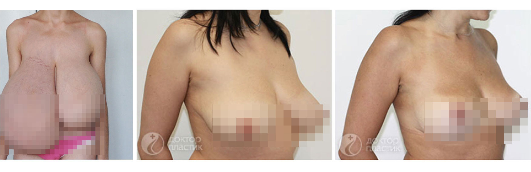 Фото до и после операции. Фото предоставлены пластическим хирургом Дмитрием Труфановым
