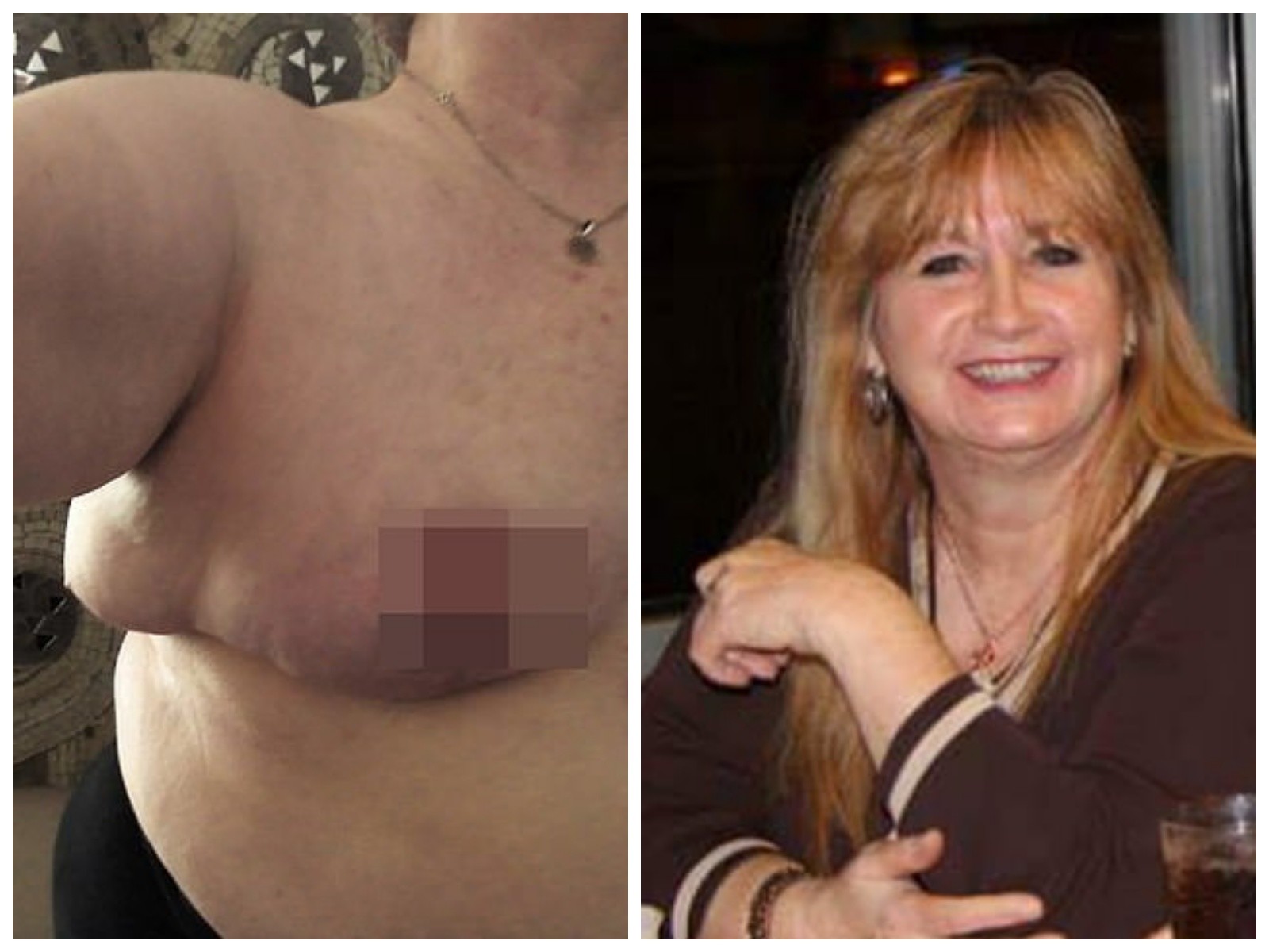 таблетки для уменьшения груди у женщин фото 91