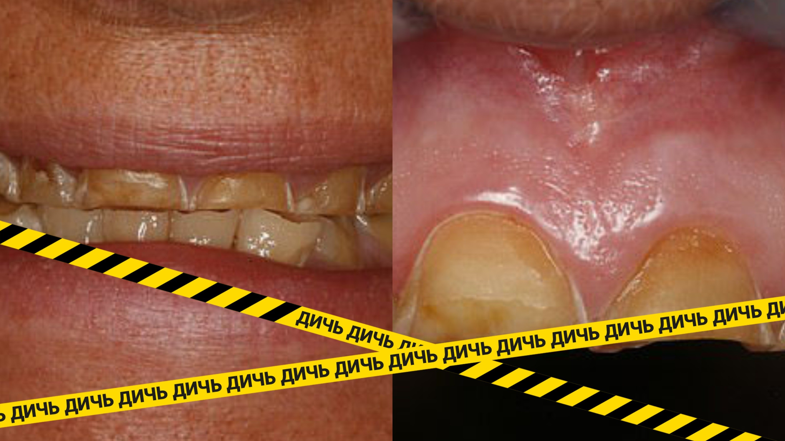 Дантист показал, с какой лёгкостью алкоголь разрушает ваши зубы: 6 фото