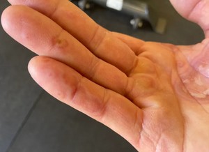 Врачи показали на фото нетипичные проявления коронавируса на пальцах рук и ног