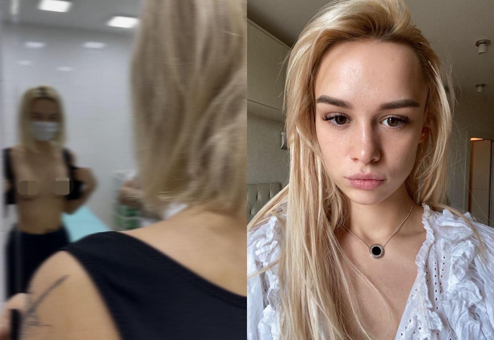 Шурыгина сняла видео в кабинете врача, показав, как выглядит её грудь после  увеличения