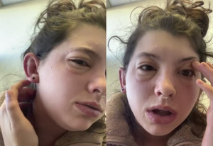Учительница в слезах записала видео, показав, что сделал с ней обычный тест на аллергены