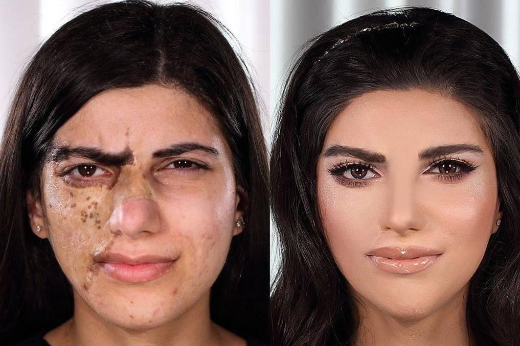 Стилист из Баку превращает девушек, чьи лица покрыты шрамами, в настоящих красавиц: 7 преображений