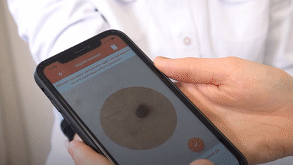 Учёные создали приложение, способное выявить онкологические заболевания кожи по фотографии — видео