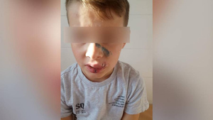 "Рвут наших детей": В Казани бездомная собака напала на ребёнка и покусала лицо