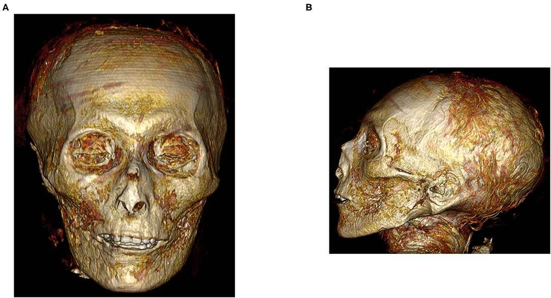 Полученное с помощью компьютерной томографии изображение черепа фараона Аменхотепа I. Фото © Frontiers in Medicine