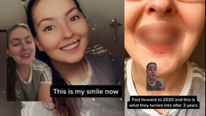 Девушка в течение 10 лет пила газировку, и вот в какое жуткое зрелище превратились её зубы — видео