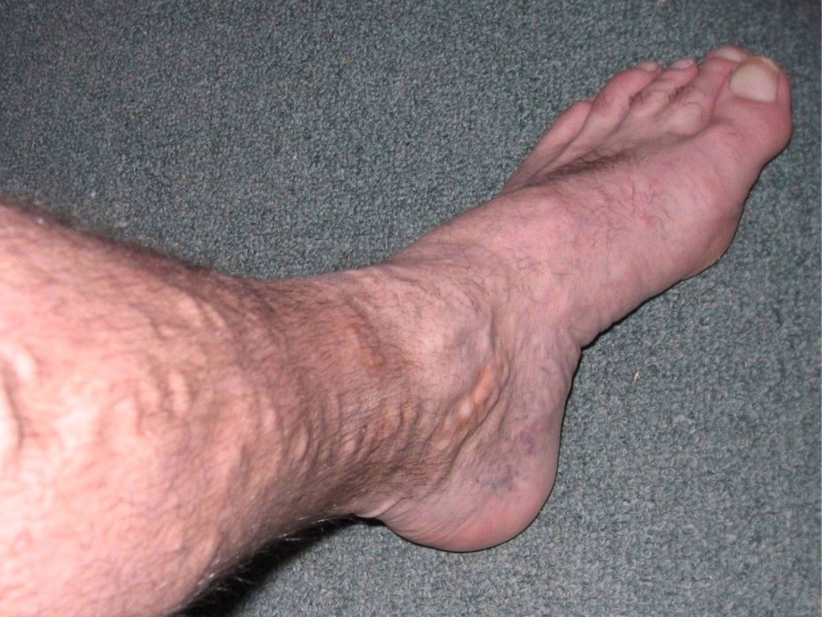 Нога с варикозными венами. Фото © Wikimedia Commons / Lakeland1999
