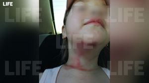 Остались кровавые борозды: В Омской области шестилетняя девочка едва не лишилась головы из-за натянутой верёвки 
