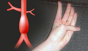 Учёные показали, как с помощью большого пальца найти у себя скрытые признаки смертельной болезни