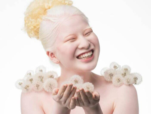 Родители избавились от дочки-альбиноса, отдав её в детдом, но спустя 16 лет красотка попала в Vogue
