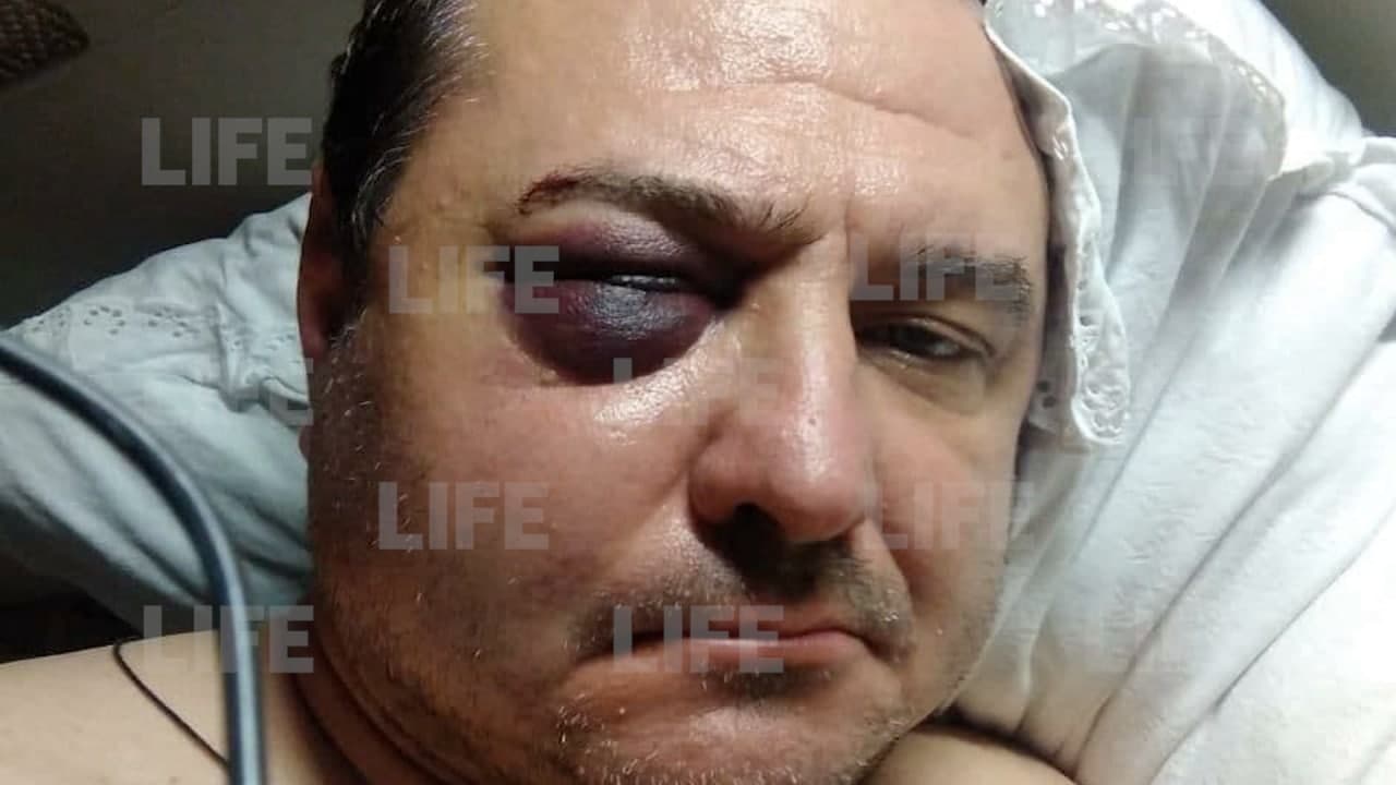 "Потерял сознание, очнулся на асфальте": Экс-солист "Лесоповала" рассказал Лайфу, как ему сломали челюсть и разбили голову в Сочи