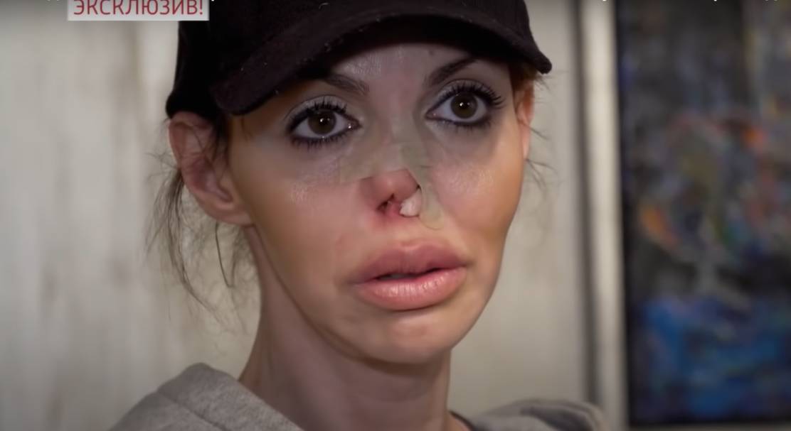 Экс-жена Аршавина о своем уродстве: вызвала косметолога, а наутро нос провалился