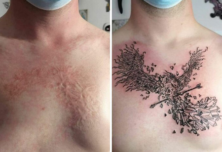 Как делаются татуировки на ожогах?