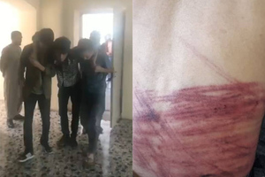 Журналисты показали страшные раны от кнутов, которыми их избили талибы за репортаж о женском митинге