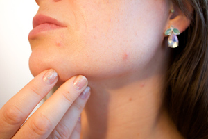 В NHS рассказали, что пятна на коже лица, шеи и ушей могут быть симптомами рака