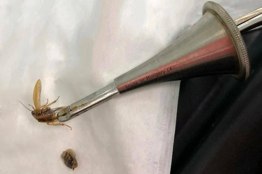 Подмосковные врачи вытащили таракана из уха страдавшего от боли пенсионера
