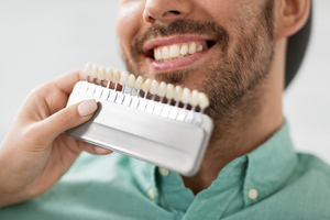 Почему чернеют виниры и как этого избежать: Советы стоматолога