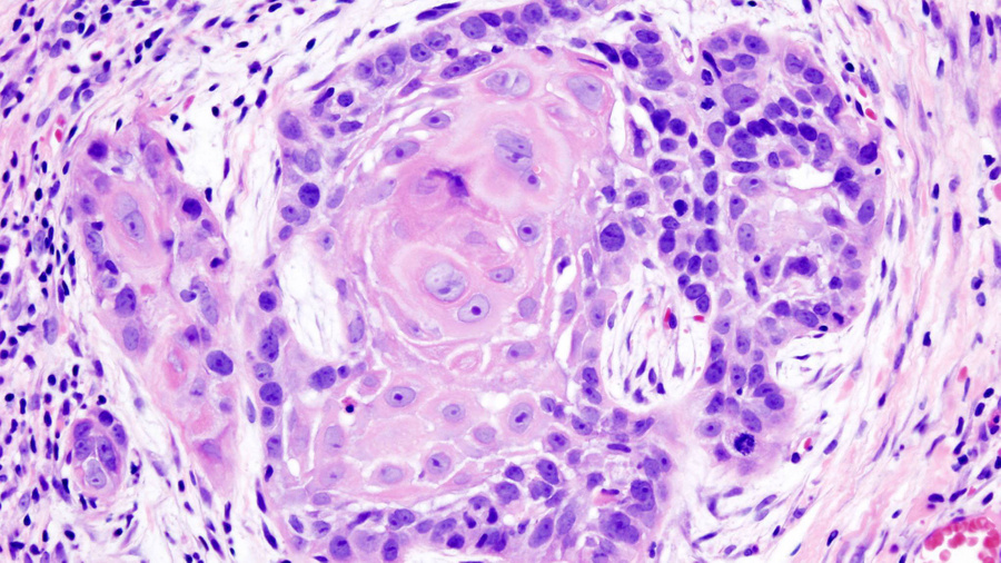Раковые клетки в образце ткани из ротовой полости. Изображение © Wikimedia Commons / KGH