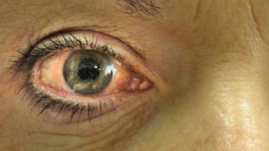 Острая закрытоугольная глаукома правого глаза. Фото © Wikimedia Commons / James Heilman, MD