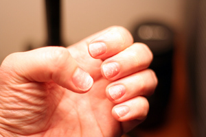 Названо восемь причин ломкости ногтей, и не все они связаны с заболеваниями