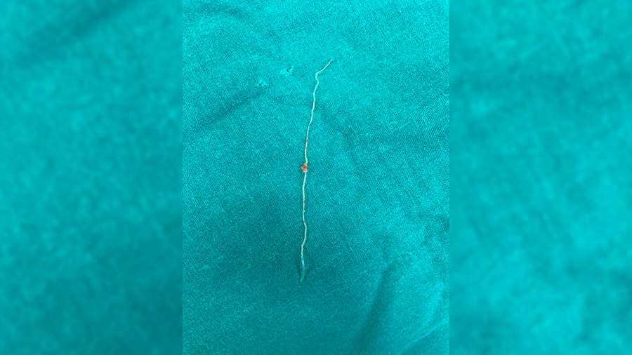 12-сантиметрового глиста, появившегося после укуса комара, извлекли из щеки женщины Люберецкие врачи. Фото предоставлено Лайфу