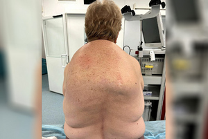 В Подмосковье врачи вырезали полуметровый жировик из спины 60-летней пациентки