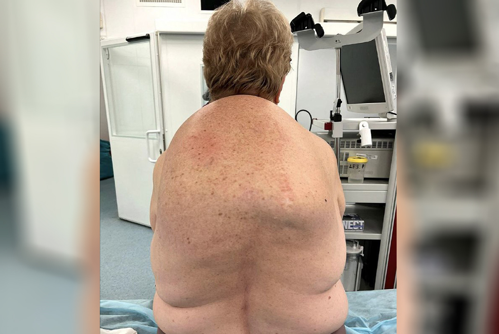 В Подмосковье врачи вырезали полуметровый жировик из спины 60-летней пациентки