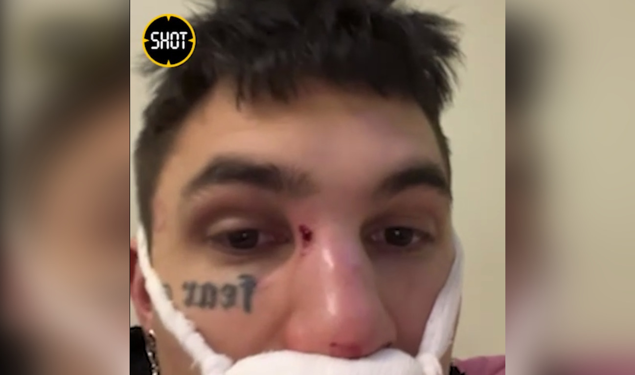 Рэперу PINQ сломали нос возле ночного клуба в Москве